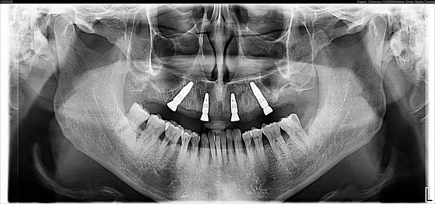 All On 4 Dental Implants