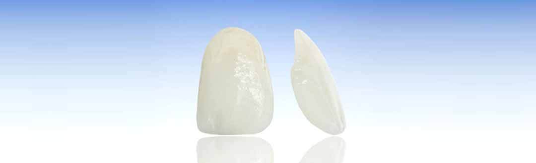 Porcelain Veneers